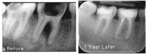 Root canals